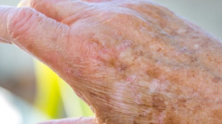¿Cómo quitar las manchas de la edad en las manos de forma natural? 2 remedios para ayudarte