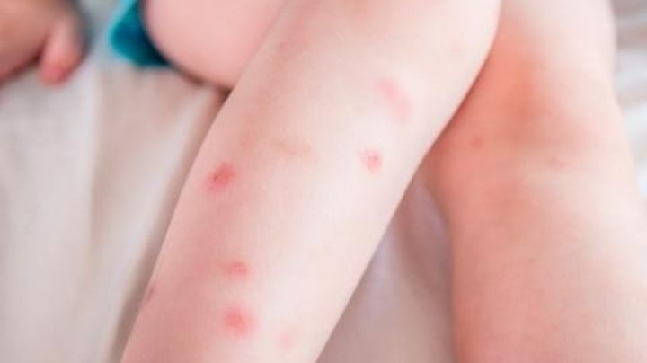 Desinflama la picadura de mosquito con remedios caseros; olvídate de la picazón en unos minutos
