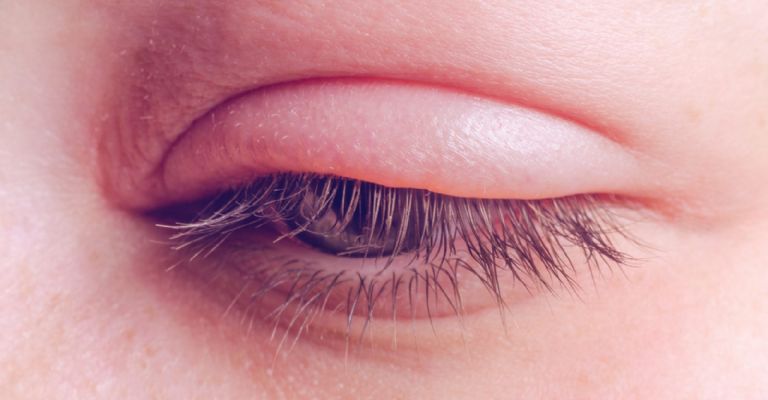 ¿Cómo sabes si tienes escarlatina? Estos son los síntomas